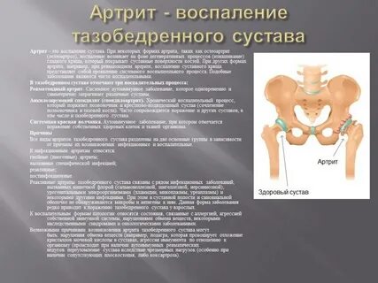 Форум больных тазобедренных суставов
