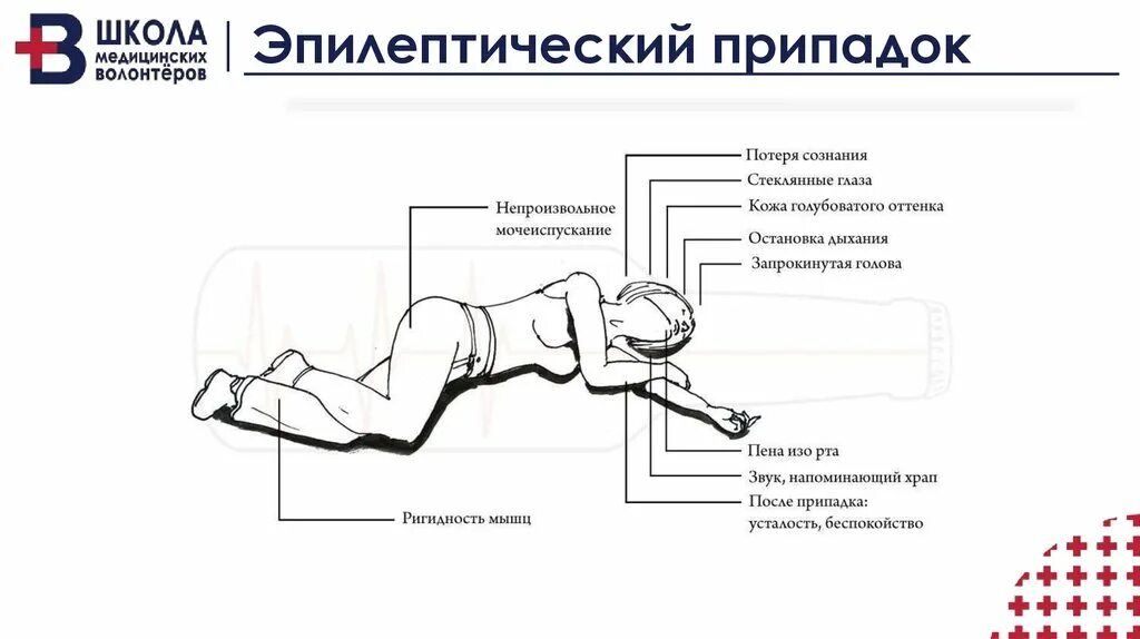 Фазы генерализованного судорожного припадка. Эпилептический припадо. Эпилепсия после припадка.