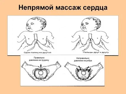 Сердечная асфиксия