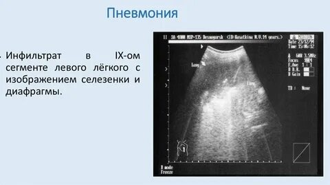 Узи плевральной полости