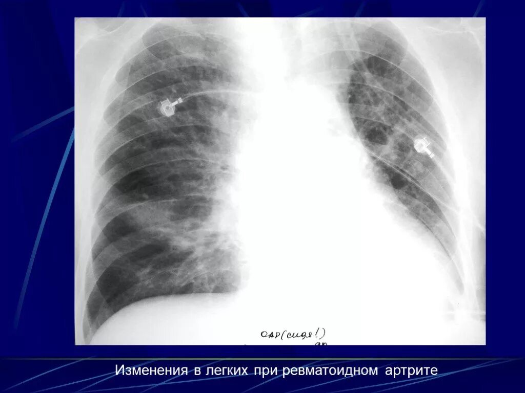 Умеренные фиброзные изменения. Изменения в легких при ревматоидном артрите рентген. Ревматические узелки в легких рентген. Изменения в лёгких при ревматоидном артрите.