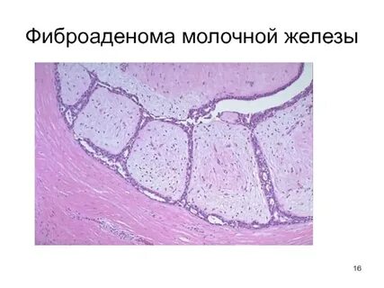 Фиброаденома железы