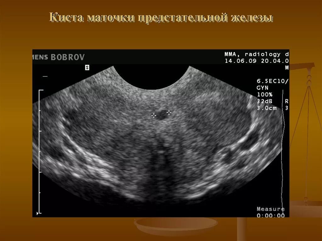 Киста маточки предстательной железы УЗИ. Киста Мюллерова протока на УЗИ. Киста простатической маточки на УЗИ. Кисты предстательной железы эхограммы. Предстательная железа включения