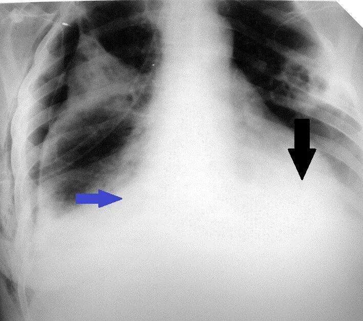 Гнойный плеврит (эмпиема). Невринома на рентгенограмме. Острая эмпиема плевры рентген. Гнойный плеврит рентгенограмма. Эмпиема легкого