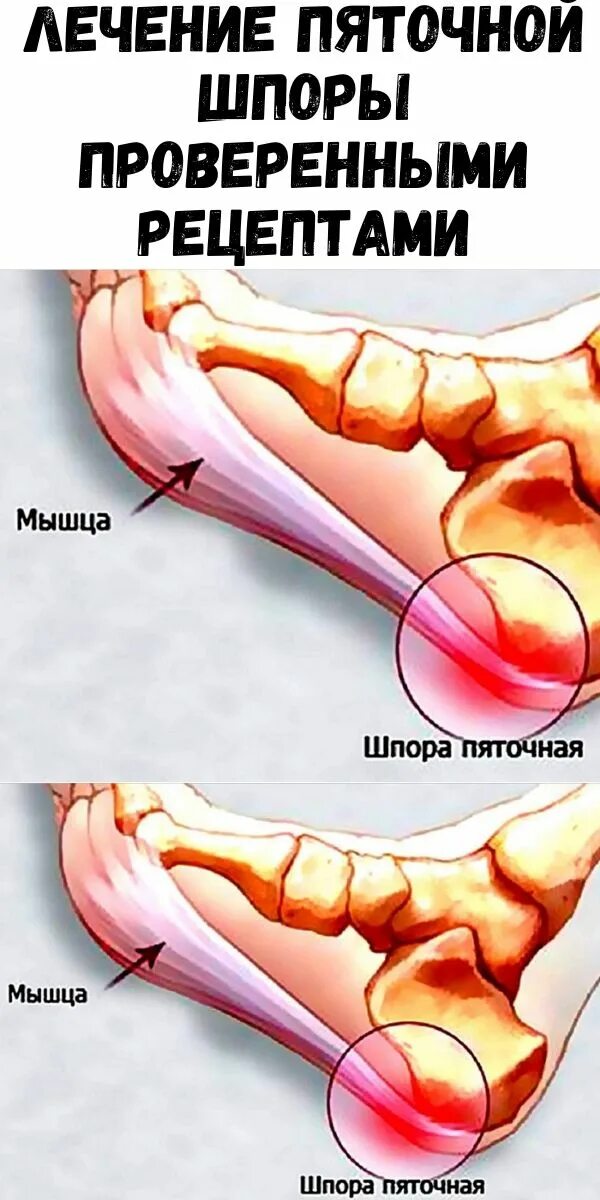 Отложение в пятке. Пяточная шпора ударно-волновая терапия. Ударно-волновая терапия (УВТ) пяточной шпоры.