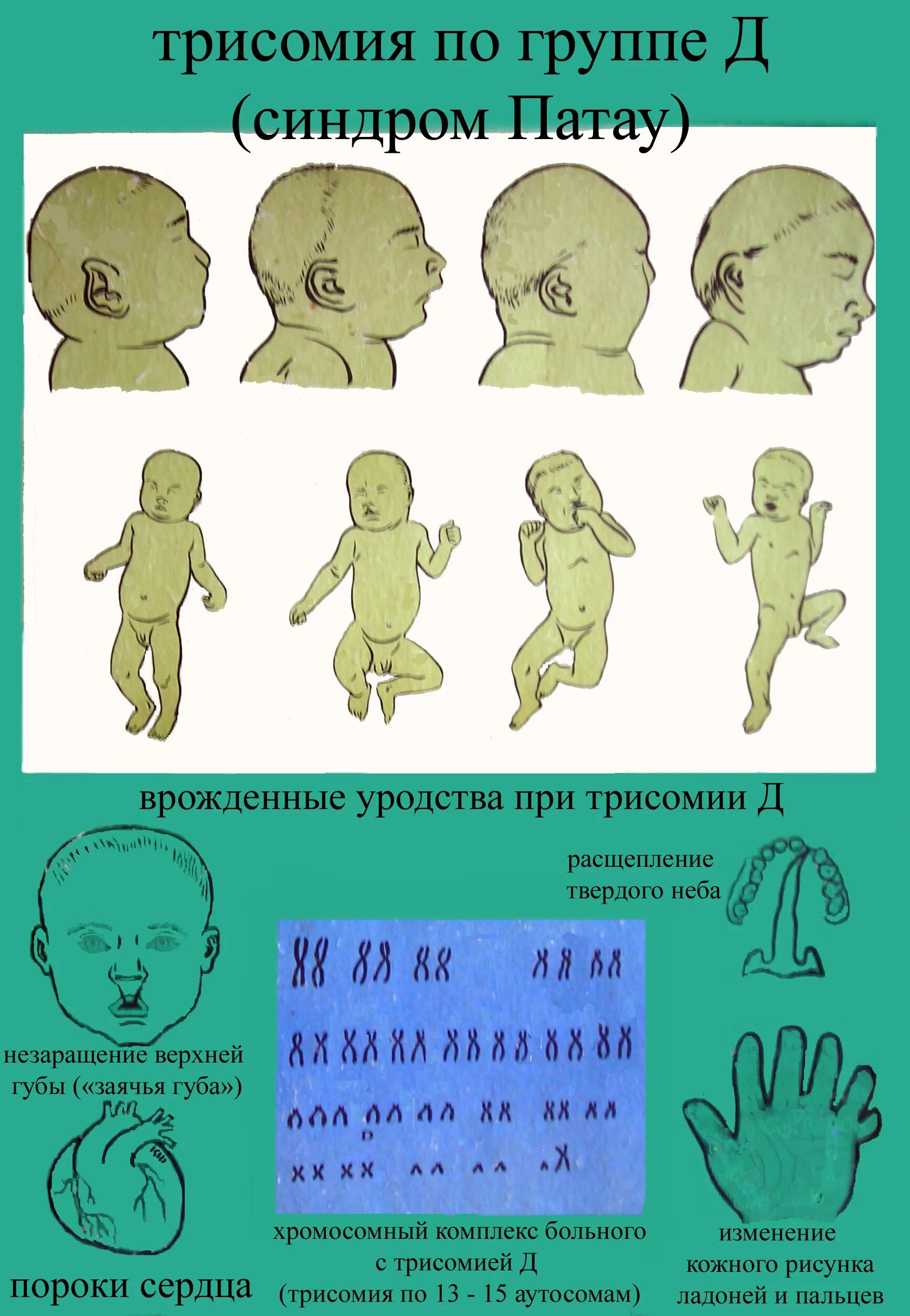 Синдром Эдвардса Патау симптомы. Хромосомные аномалии (синдром Патау, трисомия 13. Хромосомные болезни синдром Патау. Синдром Патау трисомия по 13 хромосоме.