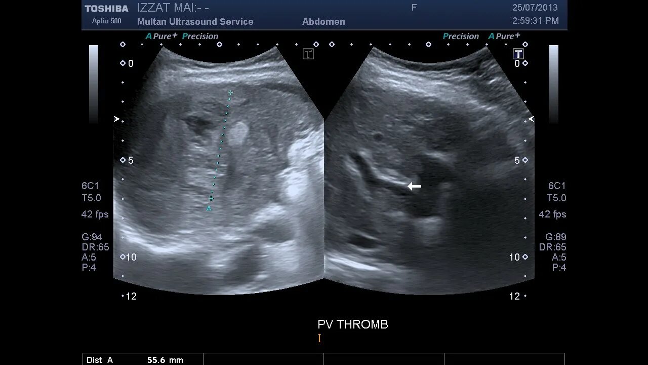Тромбоз воротной вены на УЗИ. Тромб в воротной Вене на УЗИ. Сгусток крови в Малом тазу на УЗИ. Тромбоз вены печени