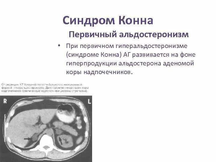 Синдром кушинга этиология. Гиперплазия коры надпочечников. Для первичного гиперальдостеронизма (синдром конна) характерно:. Гормонально активные опухоли надпочечников. Альдостерома макропрепарат.