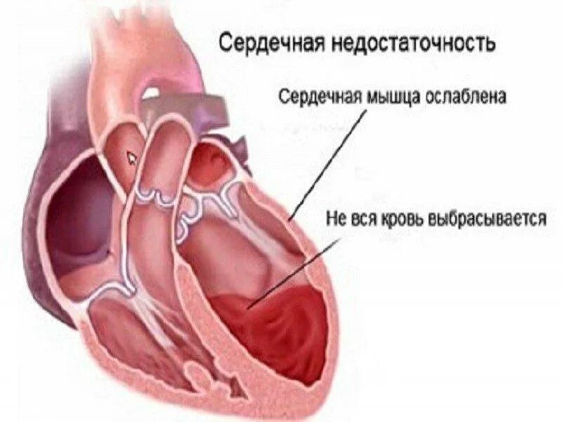 Ослабление работы сердца. Сердечная недостаточность. ослабление мышцы сердца. правосторонняя сердечная недостаточность. сердце при сердечной недостаточности.