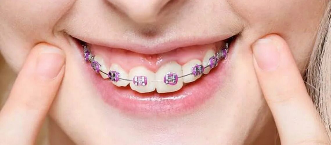 Сколько стоят брекеты в барнауле. Брекеты с бриллиантами фото. sapphire braces. серия брекета.