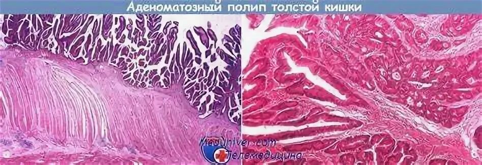Полипоз толстой
