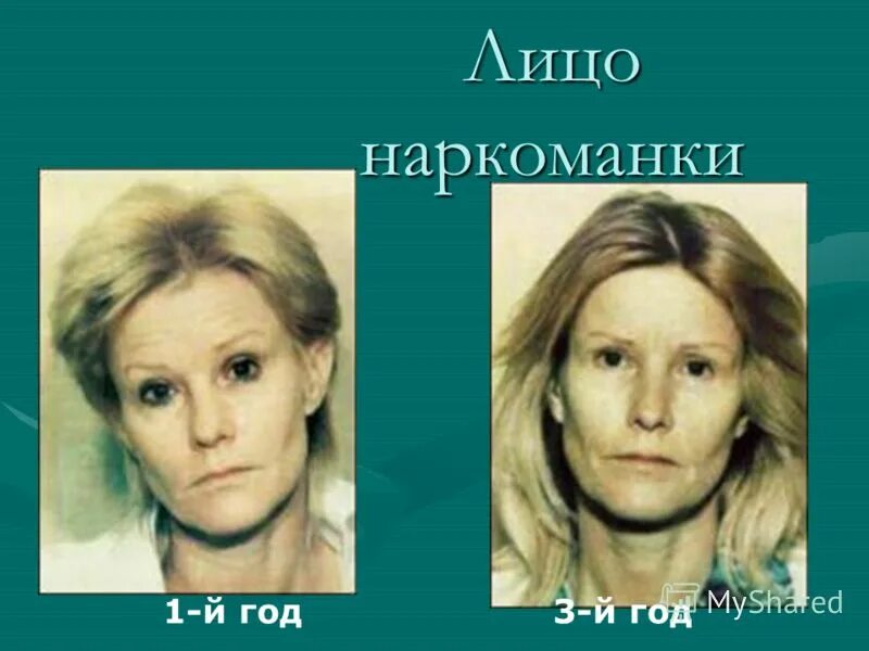 последствия наркомании. люди до и после наркотиков. алкогольное лицо женщины. люди до и посленаротиков. алкоголизм на лице женщины.