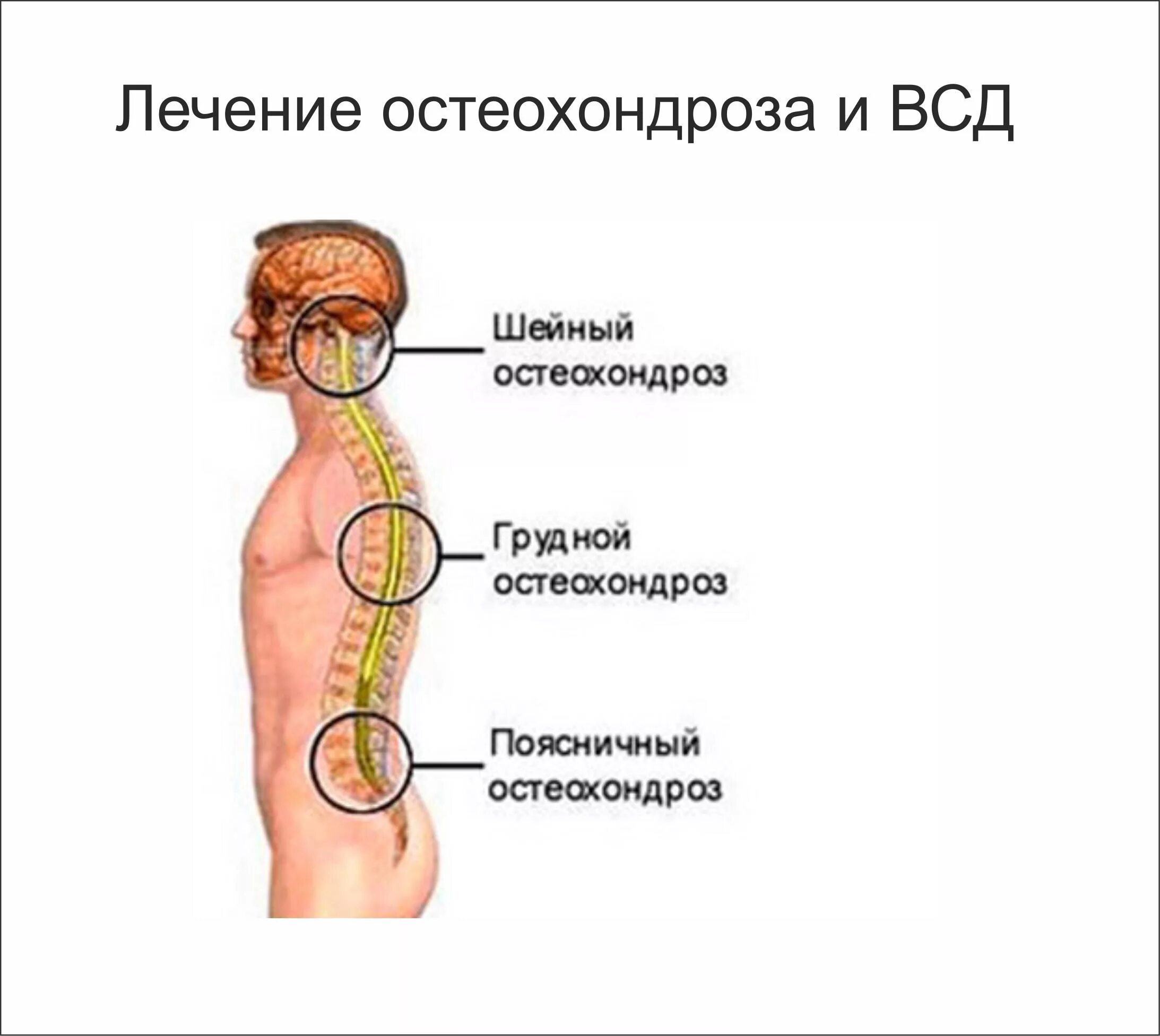 Лечение острого остеохондроза. Остеохондроз. Остеохондроз лечение. Полисегментарный остеохондроз. Шейно-грудной остеохондроз.