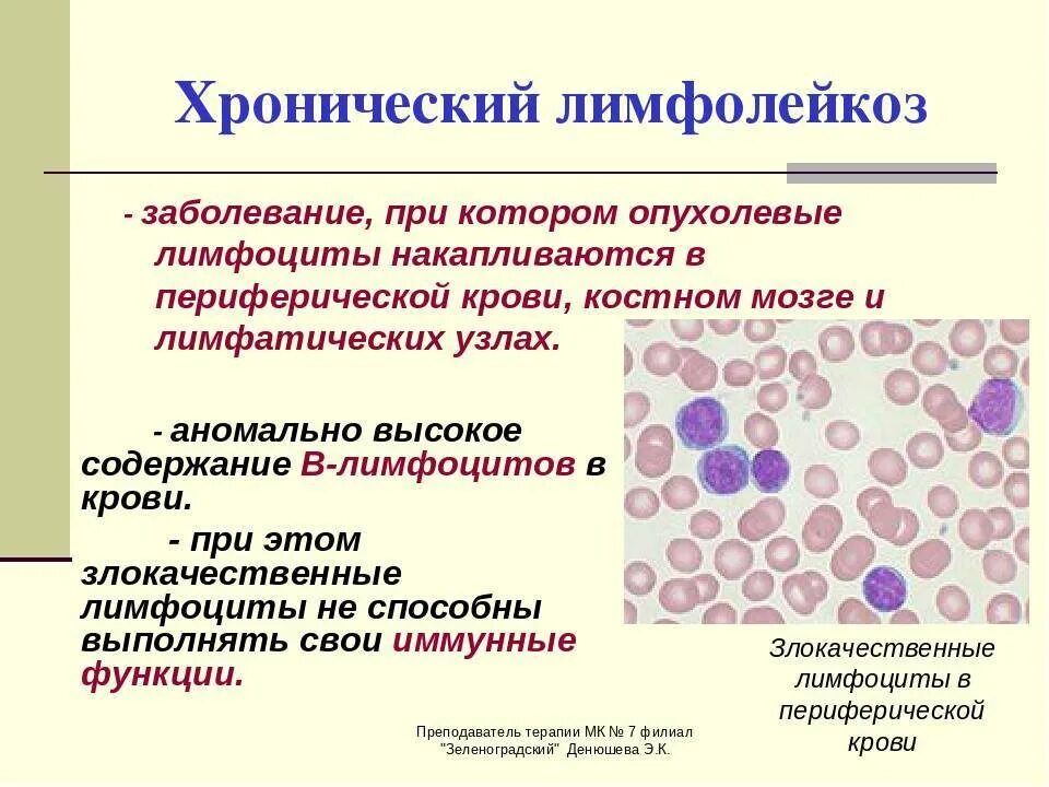 Какие признаки заболевание крови. Хронический лимфолейкоз бластные клетки. Хронические лимфицитик лейкоз. Лимфоцит хронический лейкоз. В -лимфоциты хронический лимфолейкоз.