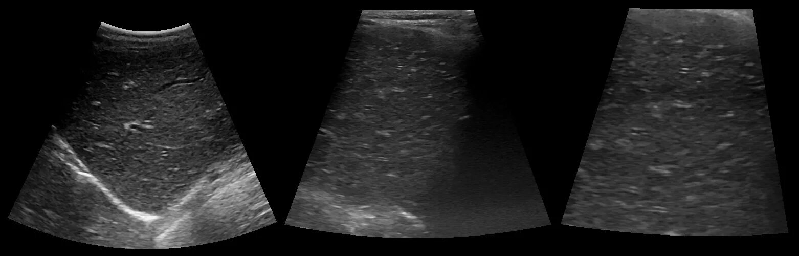 Холангит у кошек. Жировой гепатоз печени на УЗИ. УЗИ гепатита цирроза печени. Жировая дистрофия печени на УЗИ. УЗИ печени Изранов.