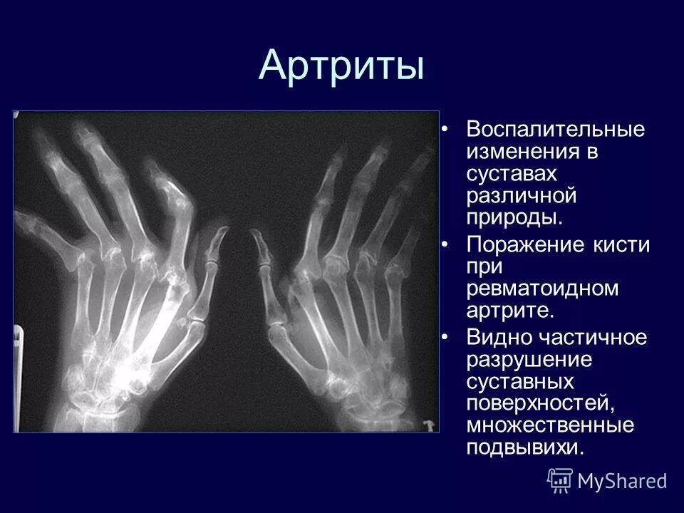 Лфк при переломе пятой пястной кости. Упражнения для разработки запястья. Лфк лучезапястного сустава после перелома. Запястно-пястный сустав 1 пальца. Аппарат artromot k1.