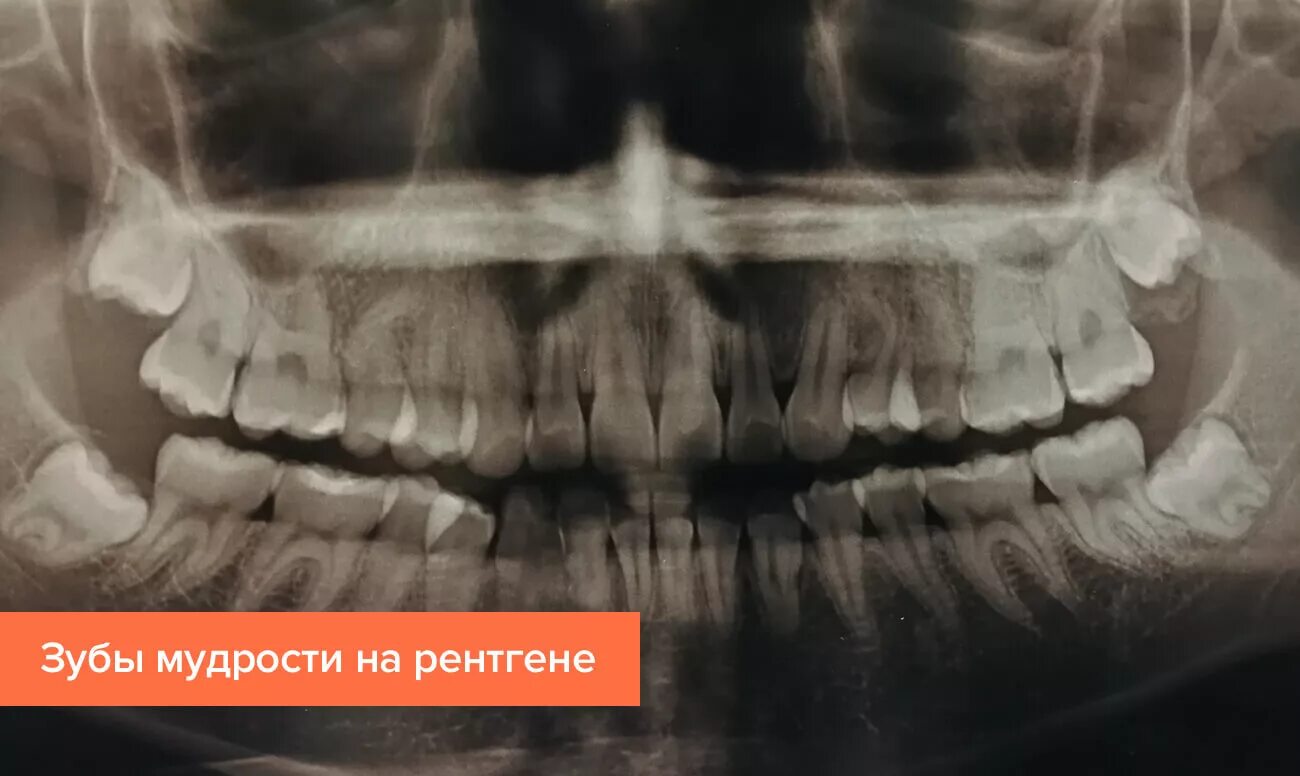 Зубы мудрости на нижней челюсти рентген. Ретинированный зуб мудрости рентген. Ретинированный зуб на верхней челюсти. Полуретинированный зуб мудрости рентген. Зуб 8 корень