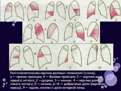 Пневмония в верхней доле левого легкого