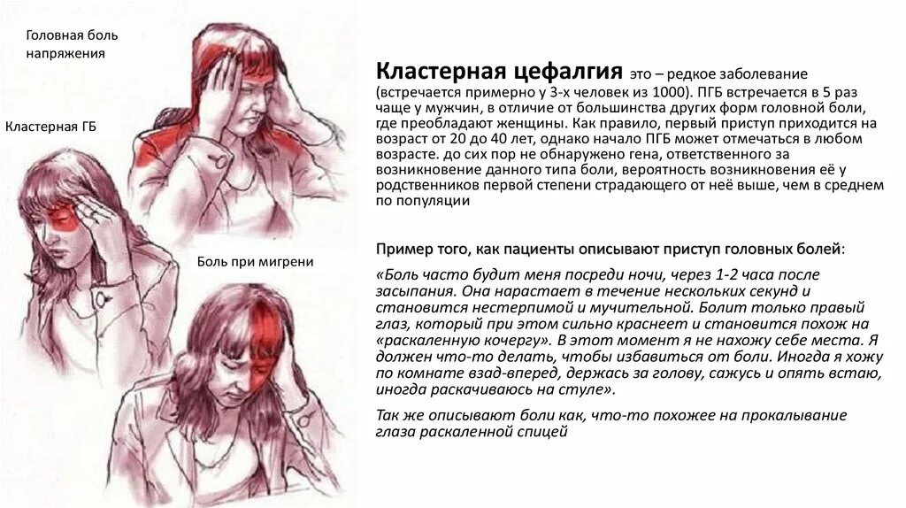 Коитальная цефалгия. Кластерная головная боль симптомы. Кла терная боль головы. Кластернарная головная бошь. Кластерная цефалгия.