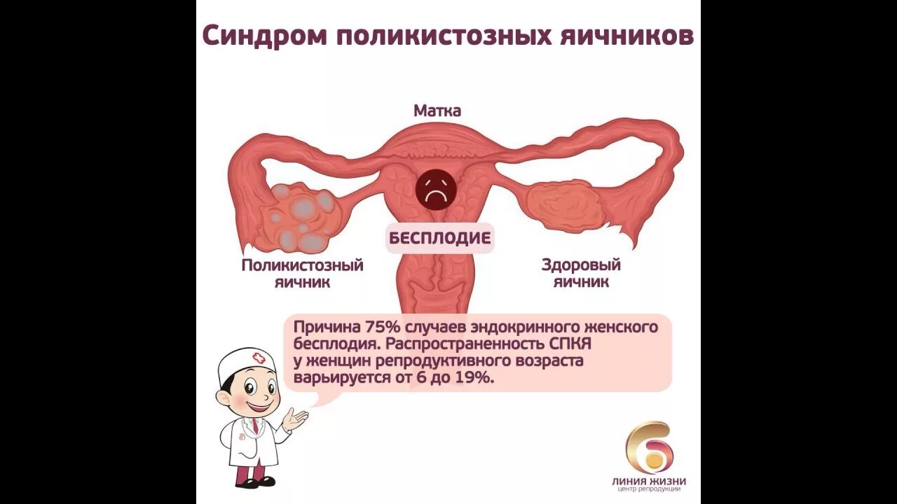 Синдром поликистозных яичников (СПКЯ). Поликистозная структура яичников. Polikistoz Yaishnikov.