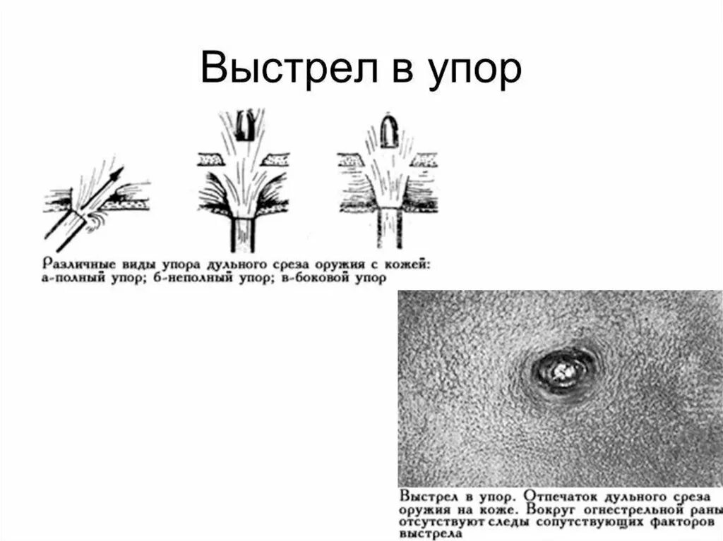 Выстрелить в упор как пишется. Огнестрельные повреждения при выстреле в упор. входное отверстие огнестрельного ранения. сквозное огнестрельное ранение.