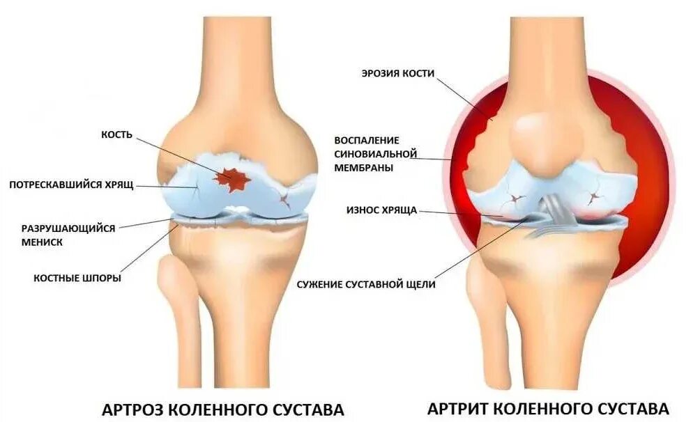 Как лечить артрит коленного сустава. Артрит и артроз коленного сустава. артрит или артроз коленного сустава отличия. остеоартроз и артрит разница. ревматоидный артрит и артроз.