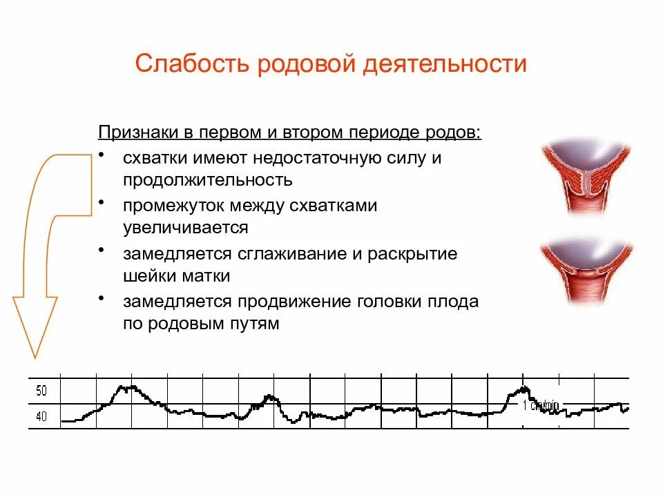 Роды признаки схваток. Слабость родовой деятельности. Первичная слабость родовой деятельности. Слабость родовая деятельность. Слабость родовой деятельности признаки.