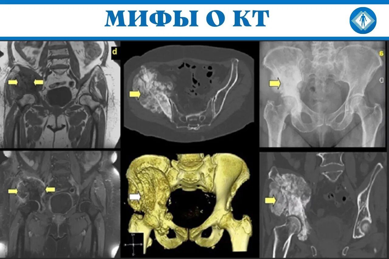 Кт органов таза у мужчин. Кт исследование малого таза с контрастированием. Исследования органов малого таза кт. Малый таз на кт томограмма. Хондросаркома костей таза кт.