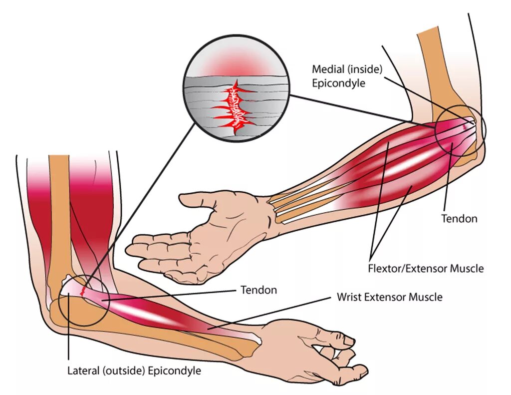 Сколько заживает сухожилие. Внешний эпикондилит локтевого сустава. Медиальный эпикондилит локтевого. Локоть теннисиста латеральный эпикондилит. Тейпирование медиального эпикондилита локтевого сустава.