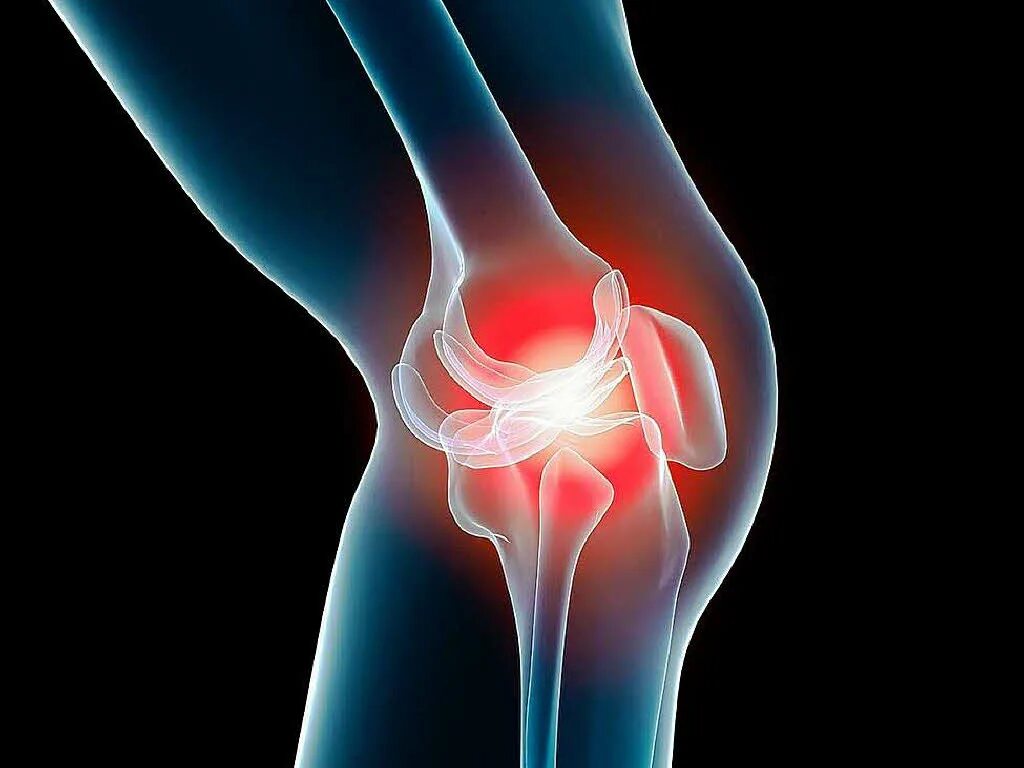 Больные коленные суставы. Полиартрит коленного сустава. Оссифицирующий тендиноз коленного сустава. Остеоартрит коленного сустава.