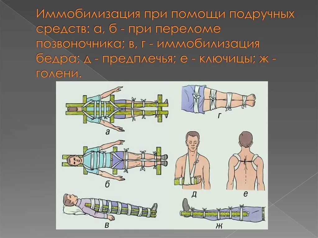 Шина при травме головы. Иммобилизация с помощью подручных средств. Иммобилизация конечности. Иммобилизация при переломе. Транспортная иммобилизация при переломе позвоночника.