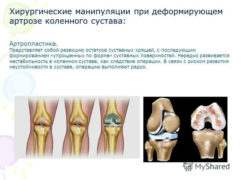 Гонартроз операции