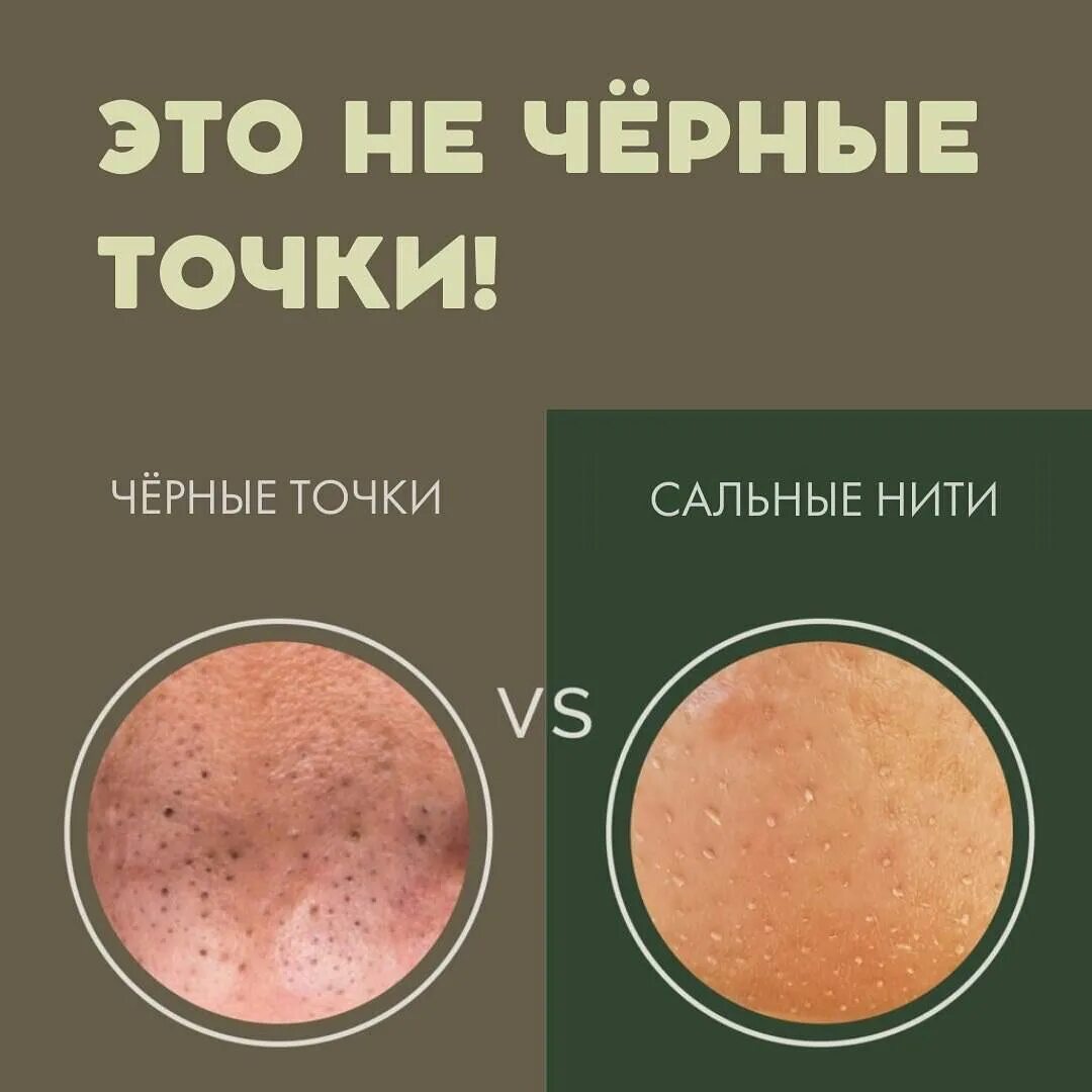 Сальные нити на лице как выглядят 3 Inspirational Quotes to Help You Clean pores YouTube