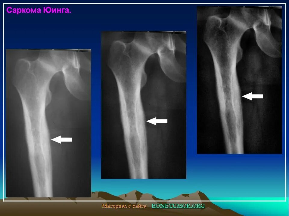 Чем отличается саркома. Саркома Юинга бедренной кости рентген. Остеосаркома бедренной кости. Рентген при саркоме Юинга.