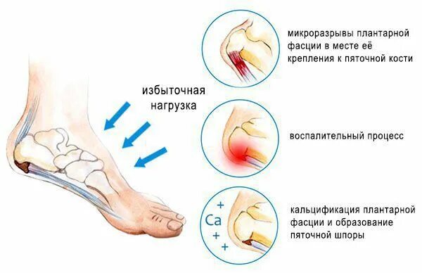 Симптомы плантарного фасциита. Признаки планетарного фасцита. Фасциит подошвенного апоневроза. Подошвенная пяточная шпора.