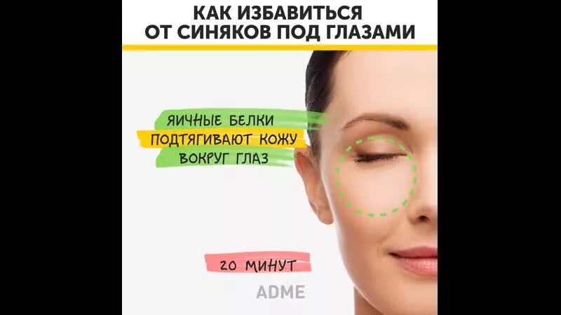 Как избавиться от синяков под глазами быстро. Избавление от синяков вокруг глаз. быстрое избавление от синяка. выведение синяков под глазами быстрое. быстрое избавление от синяков под глазами.