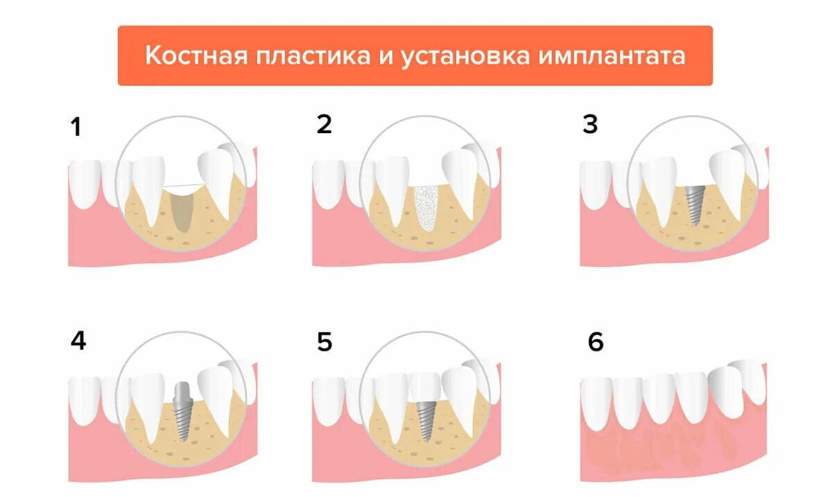 Костная пластика (остеопластика). Пластика кости при имплантации костной ткани. Наращивание кости на челюсть для имплантации.