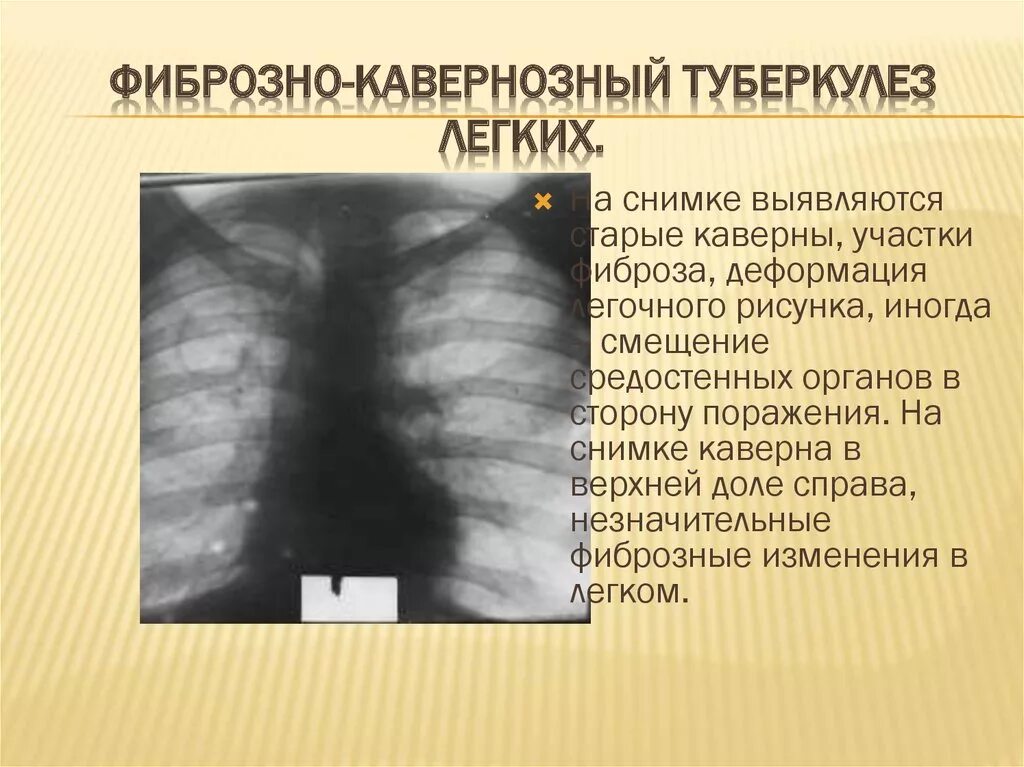 Каверна при туберкулезе на рентгене. Фиброзно-кавернозный туберкулёз легких рентгенограмма. Фиброз на рентгене легких описание. Фиброзно-кавернозный туберкулез рентген заключение. Легкие фиброзного характера