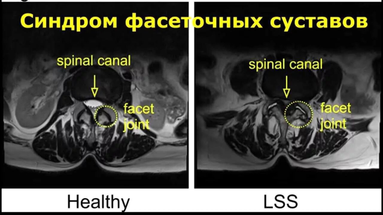 Гипертрофия суставных. Гипертрофия суставных. Артроз фасеточного сустава поясничного отдела. Гипертрофия суставных. Фасеточные суставы позвоночника симптомы.