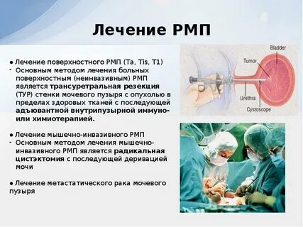 Лечение рака мочевого пузыря