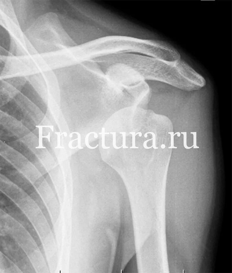 Вывих плечевого сустава вверх. Привычный вывих плеча симптомы. Вывих плеча вверх. Подвывих плеча рентген. Осложнения вправления вывиха плеча.