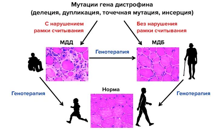 Ген дистрофии. Этиология миодистрофии дюшенна. мутация гена при миодистрофии дюшенна. генная терапия миодистрофии дюшенна. миодистрофия дюшенна-беккера патогенез.