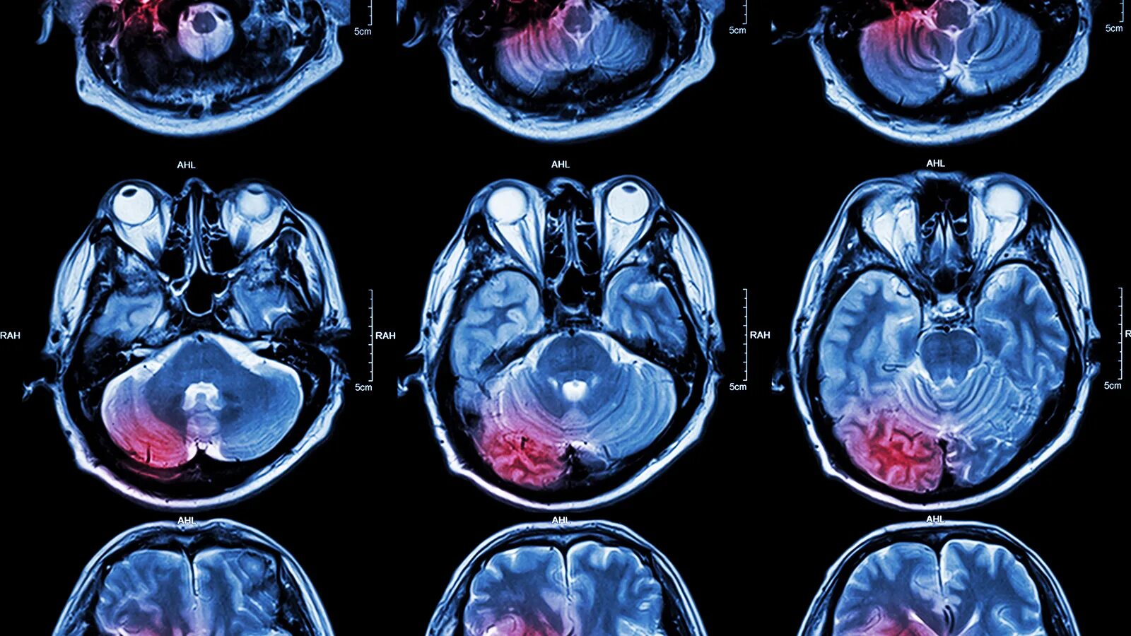 Мрт глазных орбит и зрительных нервов. Эндокринная офтальмопатия мрт. Мрт венография сосудов головного мозга. Кт показывает нервы. Кт показывает нервы.