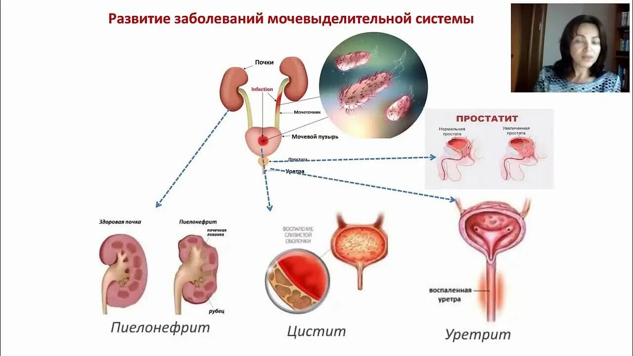 Профилактика заболеваний органов мочевыделительной системы. Схема заболеваний мочевыделительной системы. Заболевания по мочевыделительной системе. Профилактика заболеваний мочевыделительной системы. Заболевания органов мочевыделительной системы у детей.