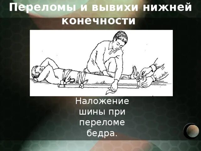 При открытом переломе перед наложением шины. Перелом и вывих нижней конечности. Наложение шины при вывихе. Накладывание шины при переломе бедра.