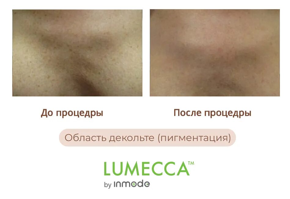 IPL Lumecca. Фотоомоложение лица Lumecca INMODE до и после. Люмекка от пигментации.