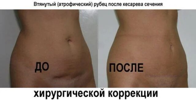 Реабилитация родильниц после кесарева сечения. Послеоперационный живот. Живот после кесарево через месяц. Швы после кеперво сечени. Швы после кеперво сечени.