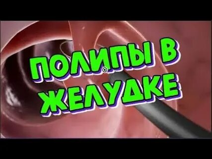 Как лечить полипы в желудке