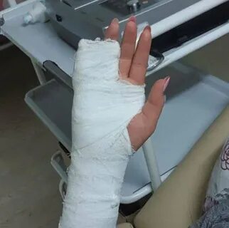 Гипс на перелом пальца