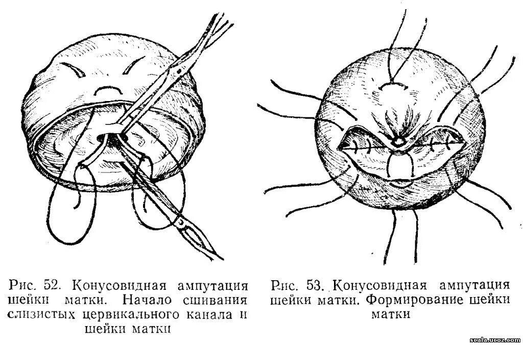 Операция Штурмдорфа пластика шейки. Операция отсечение шейки матки. Конусовидная ампутация шейки ( по Штурмдорфу). Ампутация шейки матки техника операции. Операции поднять матку